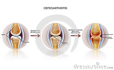 Osteoarthritis detailed illustration Vector Illustration