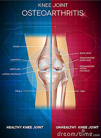 Osteoarthritis Vector Illustration