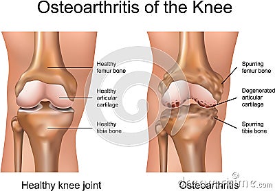 Osteoarthritis of the Knee Vector Illustration
