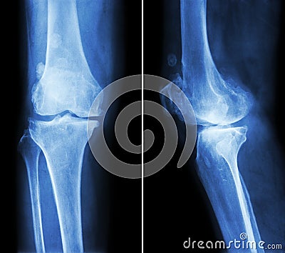 Osteoarthritis knee . film x-ray knee ( anterior - posterior and lateral view ) show narrow joint space , osteophyte ( spur ) , Stock Photo