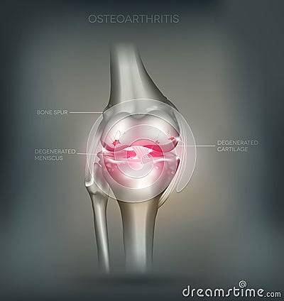 Osteoarthritis knee joint destruction Vector Illustration