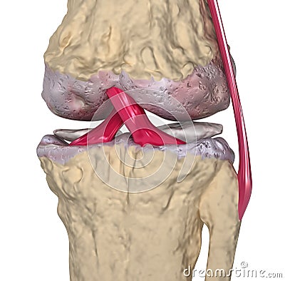 Osteoarthritis : Knee joint with ligaments Stock Photo