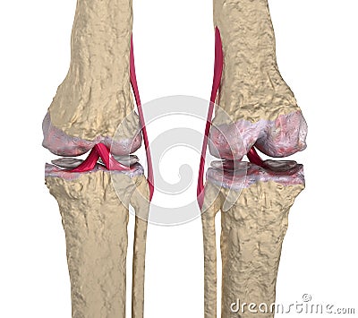 Osteoarthritis : Knee joint with ligaments and car Stock Photo