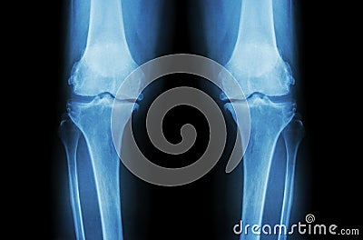 Osteoarthritis Knee ( OA Knee ). Film x-ray both knee ( front view ) show narrow joint space ( joint cartilage loss ) , osteophyte Stock Photo