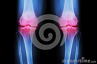 Osteoarthritis Knee ( OA Knee ). Film x-ray both knee ( front view ) show narrow joint space ( joint cartilage loss ) , osteophyte Stock Photo