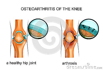 Osteoarthritis of the knee Vector Illustration