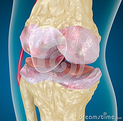 Osteoarthritis : Knee Stock Photo