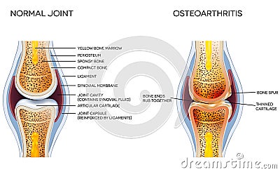 Osteoarthritis Vector Illustration