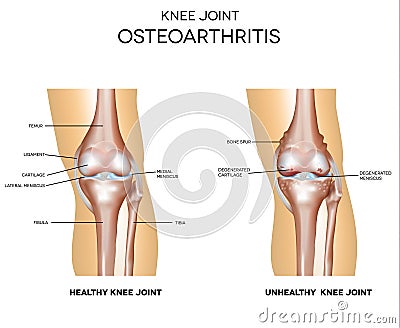 Osteoarthritis and normal joint Vector Illustration