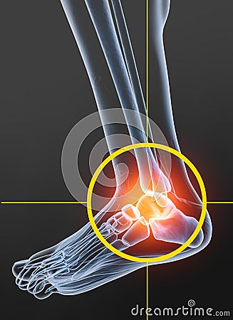 Osteoarthritis, painful ankle joint, 3D illustration Cartoon Illustration