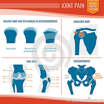 Osteoarthritis and rheumatism joint pain medical vector infographic Vector Illustration