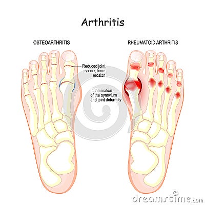 Osteoarthritis, rheumatoid arthritis, and posttraumatic arthritis Vector Illustration