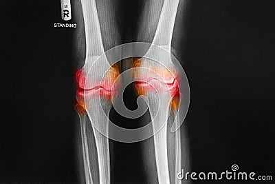 Osteoarthritis Right knee film x-ray AP anterior - posterior of knee Stock Photo