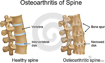 Osteoarthritis of Spine Vector Illustration