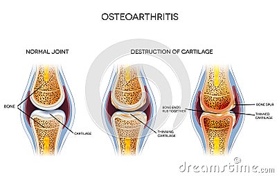 Osteoarthritis, unhealthy joint Vector Illustration