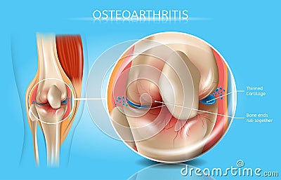 Osteoarthritis Realistic Vector Medical Scheme Vector Illustration