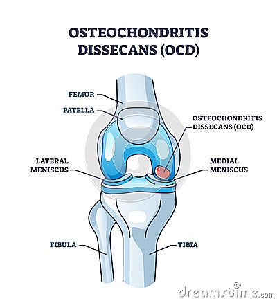 Osteochondritis dissecans or OCD bone and cartilage condition outline diagram Vector Illustration