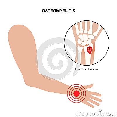 Osteomyelitis of arm Vector Illustration
