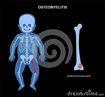 Osteomyelitis in children Vector Illustration