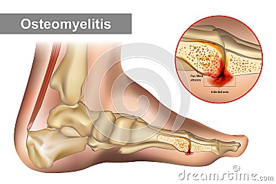 Osteomyelitis is an infection of bone. Diagram shows osteomyelitis of a humans foot bone. Vector Illustration