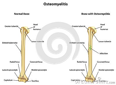 Osteomyelitis Infection Vector Illustration