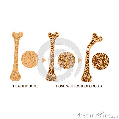 Osteoporosis Bone Infographics Concept Card Poster. Vector Vector Illustration