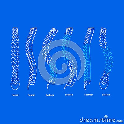 Osteoporosis Bone Types Infographics Concept Card Poster Contour Linear Style. Vector Vector Illustration