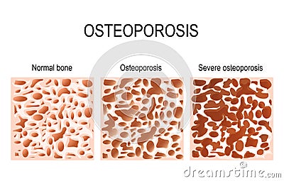 Osteoporosis - is a disease of bones that leads to an increased Vector Illustration