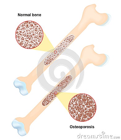 Osteoporosis. disease of bones Vector Illustration
