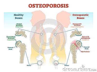 Osteoporosis examples vector illustration diagram with bone density. Vector Illustration