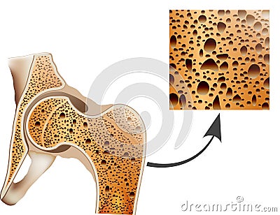 Osteoporosis in femur bone Vector Illustration