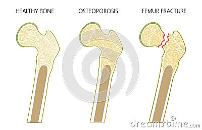 Osteoporosis 3_with femur fracture and dislocation Vector Illustration