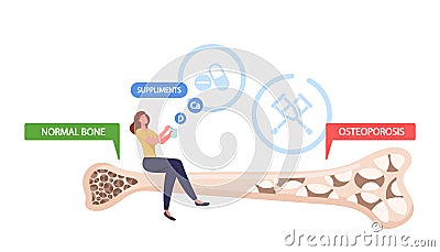 Osteoporosis, Health Care. Tiny Female Character Sitting on Huge Bone Cross Section with Normal and Porous Structure Vector Illustration