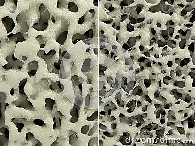 Osteoporosis, healthy leftI and osteoporotic right bone tissue Stock Photo