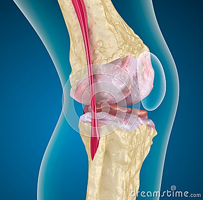 Osteoporosis of the knee joint. Stock Photo