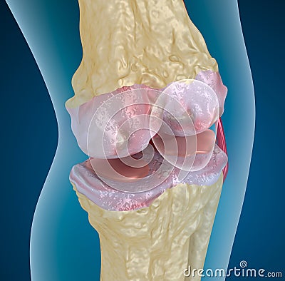 Osteoporosis of the knee joint Stock Photo