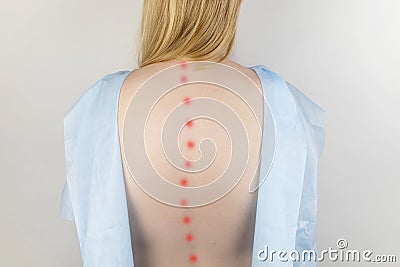 A woman at the doctor`s appointment with back pain. Treatment of spinal deformity and stoop. Osteoporosis, kyphosis, lordosis, or Stock Photo