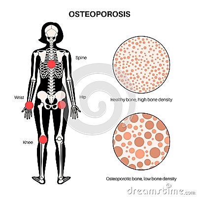 Osteoporosis medical poster Vector Illustration