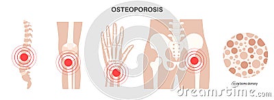 Osteoporosis medical poster Vector Illustration