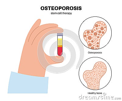 Osteoporosis medical poster Vector Illustration
