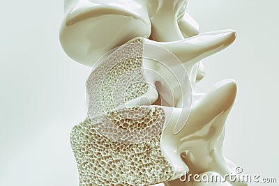 Osteoporosis on the spine - 3d rendering Stock Photo