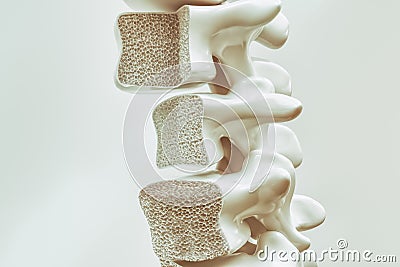 Osteoporosis on the spine - 3d rendering Stock Photo