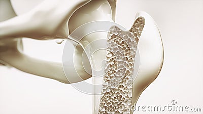 Osteoporosis stage 4 of 4 - upper limb bone - 3d rendering Stock Photo