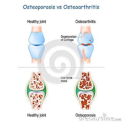 Osteoporosis vs Osteoarthritis Vector Illustration