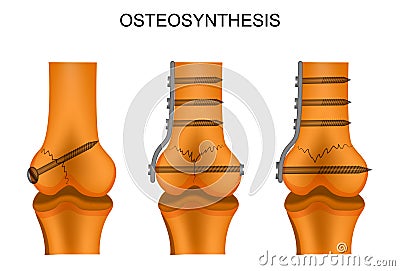 Osteosynthesis of the femur Vector Illustration