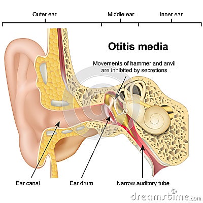 Otitis media ear disease 3d medical vector illustration on white background Vector Illustration