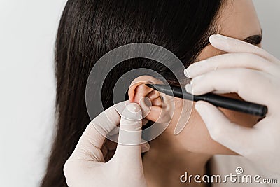 Otoplasty markup close-up before ear surgery. Surgeon draw marking on ear before otoplasty cosmetic surgery. Otoplasty Stock Photo