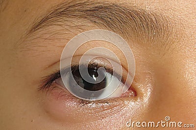 Outer view of nodule shaped style- chalazion on the lower eyelid of child. Papilledema Stock Photo