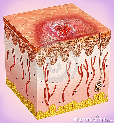 Outline of a skin cancer Stock Photo