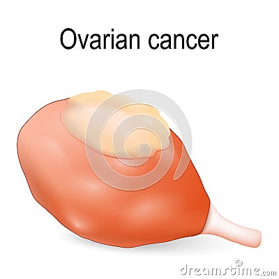 Ovarian cancer Vector Illustration